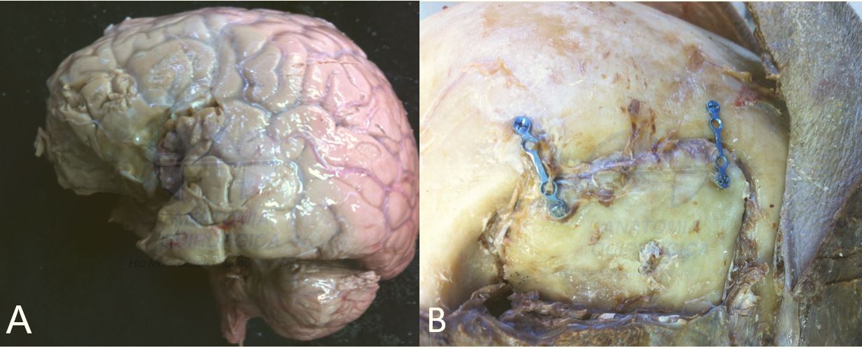 Glioblastoma